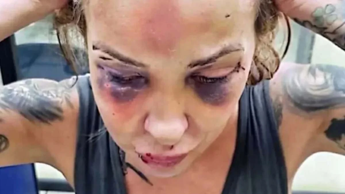 Após ter sido mantida em cárcere privado e agredida por três dias pelo namorado no Rio de Janeiro, a jornalista Ana Luíza, de 37 anos, denunciou à polícia as agressões que deixaram lesões na mandíbula e no crânio.