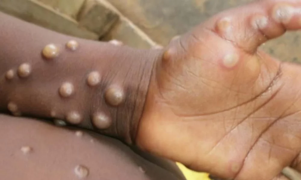 O mundo ultrapassou os 500 casos de varíola dos macacos fora da África na segunda-feira (30). Os dados são do Global.health Monkeypox, que monitora os números divulgados por cada nação.