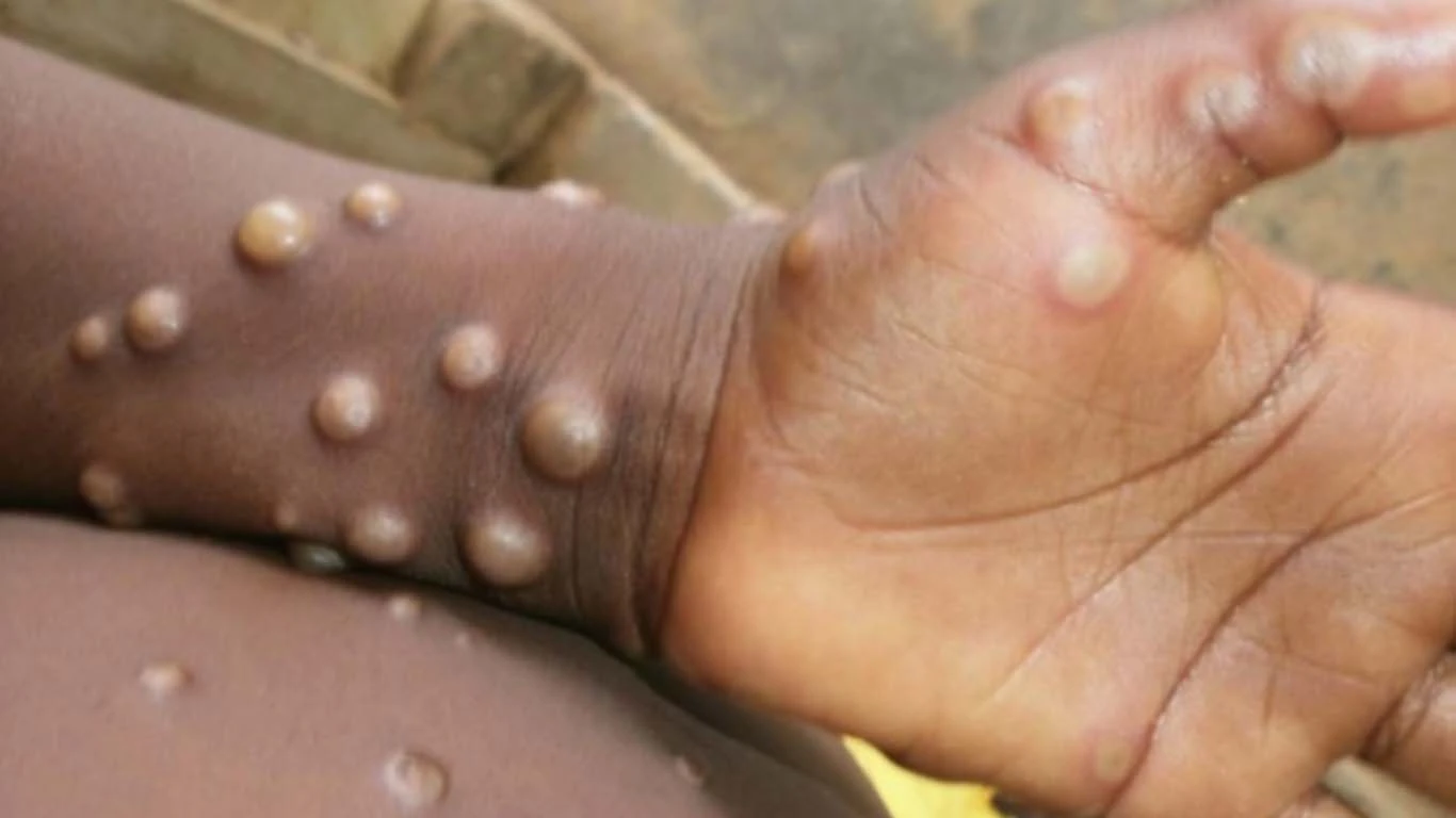 O mundo ultrapassou os 500 casos de varíola dos macacos fora da África na segunda-feira (30). Os dados são do Global.health Monkeypox, que monitora os números divulgados por cada nação.