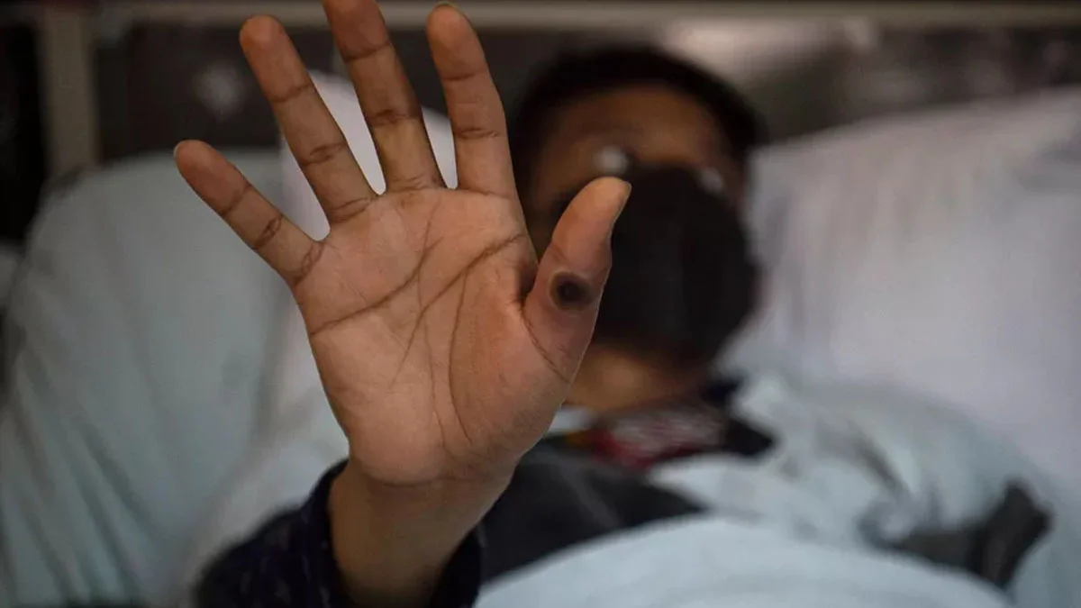 Um homem de 36 anos na Itália se tornou o primeiro caso por ter testado positivo para infecção simultânea pela varíola dos macacos, a Covid-19 e o HIV. As informações são do O Globo.