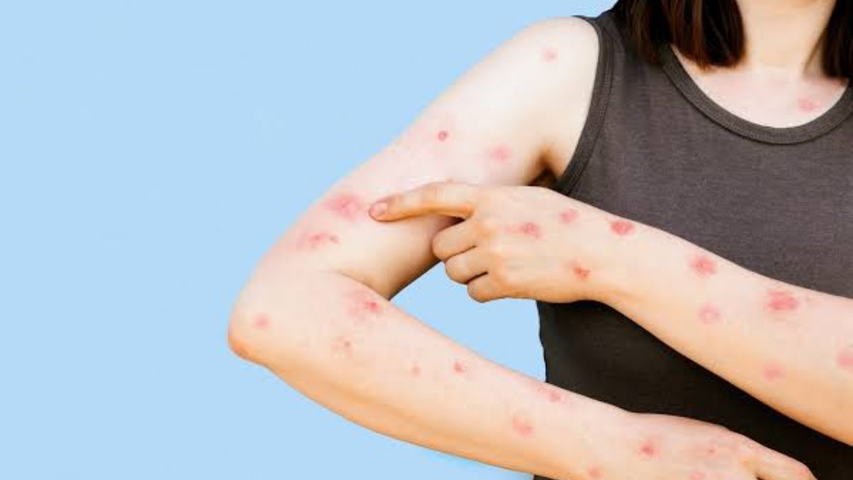 A Bahia teve o registro de cinco novos casos confirmados de Monkeypox nesta quarta-feira (8). As notificações são relativas