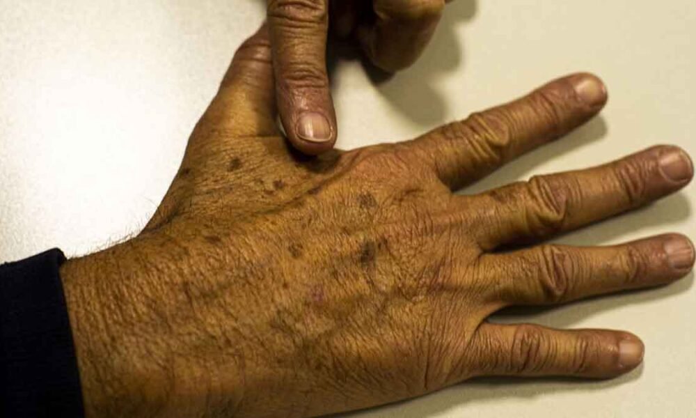 Pacientes do Sistema Único de Saúde (SUS) com o tipo de câncer de pele mais comum vão ter um novo tratamento desenvolvido por pesquisadores da Universidade de São Paulo (USP). A tecnologia 100% nacional promete um tratamento rápido, com menos desconforto e foi aprovado para uso na saúde pública. 